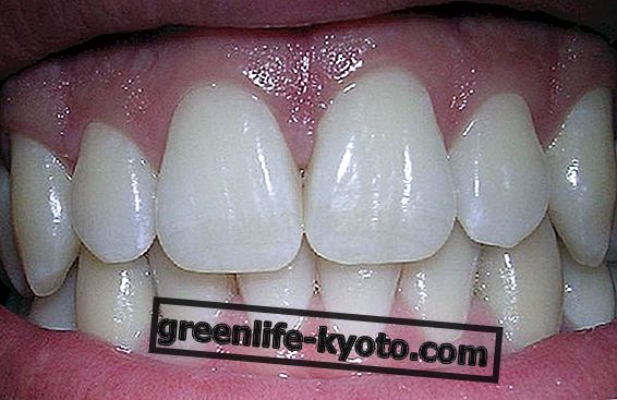 Điều trị sâu răng bằng fluoride