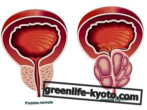 Prostatitis: simptomi, vzroki, vsa zdravila