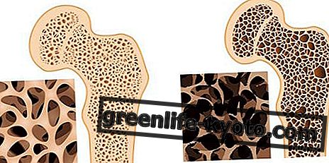 Osteoporoza: simptome, cauze, toate căile de atac