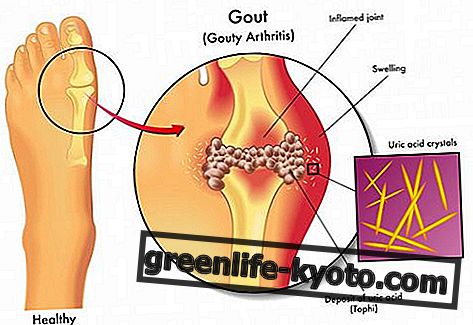 Gout: triệu chứng, nguyên nhân, tất cả các biện pháp khắc phục