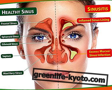 Sinusitis: gejala, sebab, semua ubat