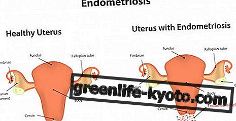 Endometriose, homeopathische natuurlijke remedies