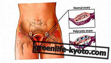 Ovariecyster: symptomer, årsaker, alle rettsmidler